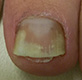 Рис. 1. Грибковое поражение ногтя (отмечается утолщение и изменение цвета ногтевой пластины, разрушение структуры ногтя)