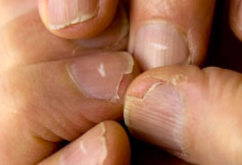 Что ногти могут рассказать о вашем здоровье?