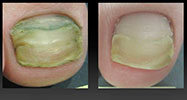 Рис. 3. Фото до и после лечения лазером грибка ногтей