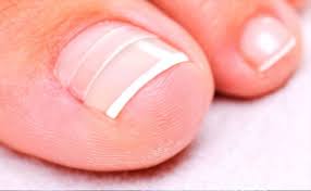 Рис. 1. Большой палец на ноге часто поражается вросшим ногтем.