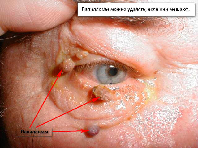 Papilom ocular - Papilom pe globul ocular - Simptomele și tratamentul paraziților subcutanati