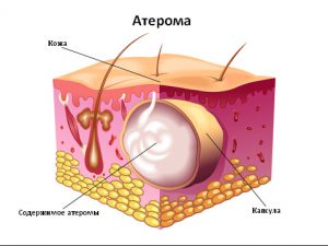 Рис. 1. Атерома - это киста сальной железы.