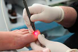 Рис. 3 Самое безболезненное и эффективное лечение вросшего ногтя при наличии нагноения - это лазерная вапоризация