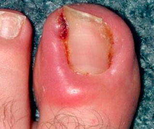 Ошибки в лечении грибка ногтей на ногах