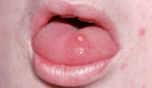 Рис. 4. Папилломы могут поражать полость рта