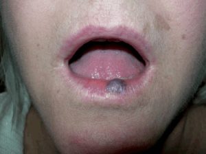 Рис. 2. Венозное озеро часто возникает в результате травмы нижней губы