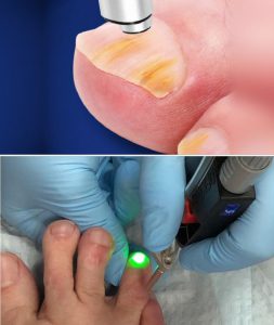 Преимущества лазерного лечения грибка ногтей на ногах