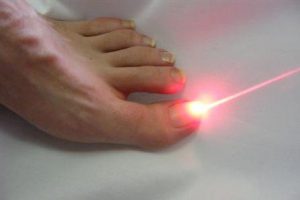 Лечение грибка ногтей на ногах лазером