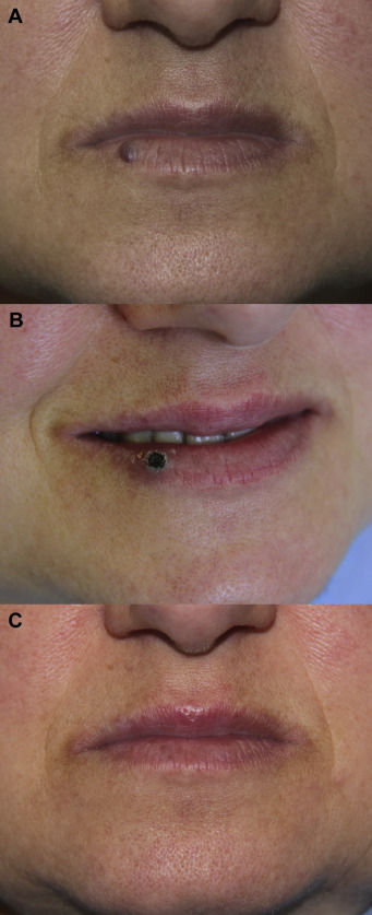 Рис. 3. Эффективность лечения гемангиомы на губе диодным лазером.